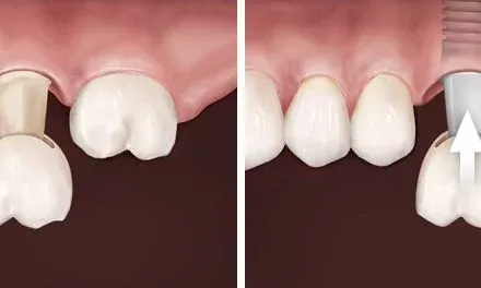 tooth-extraction-donts1