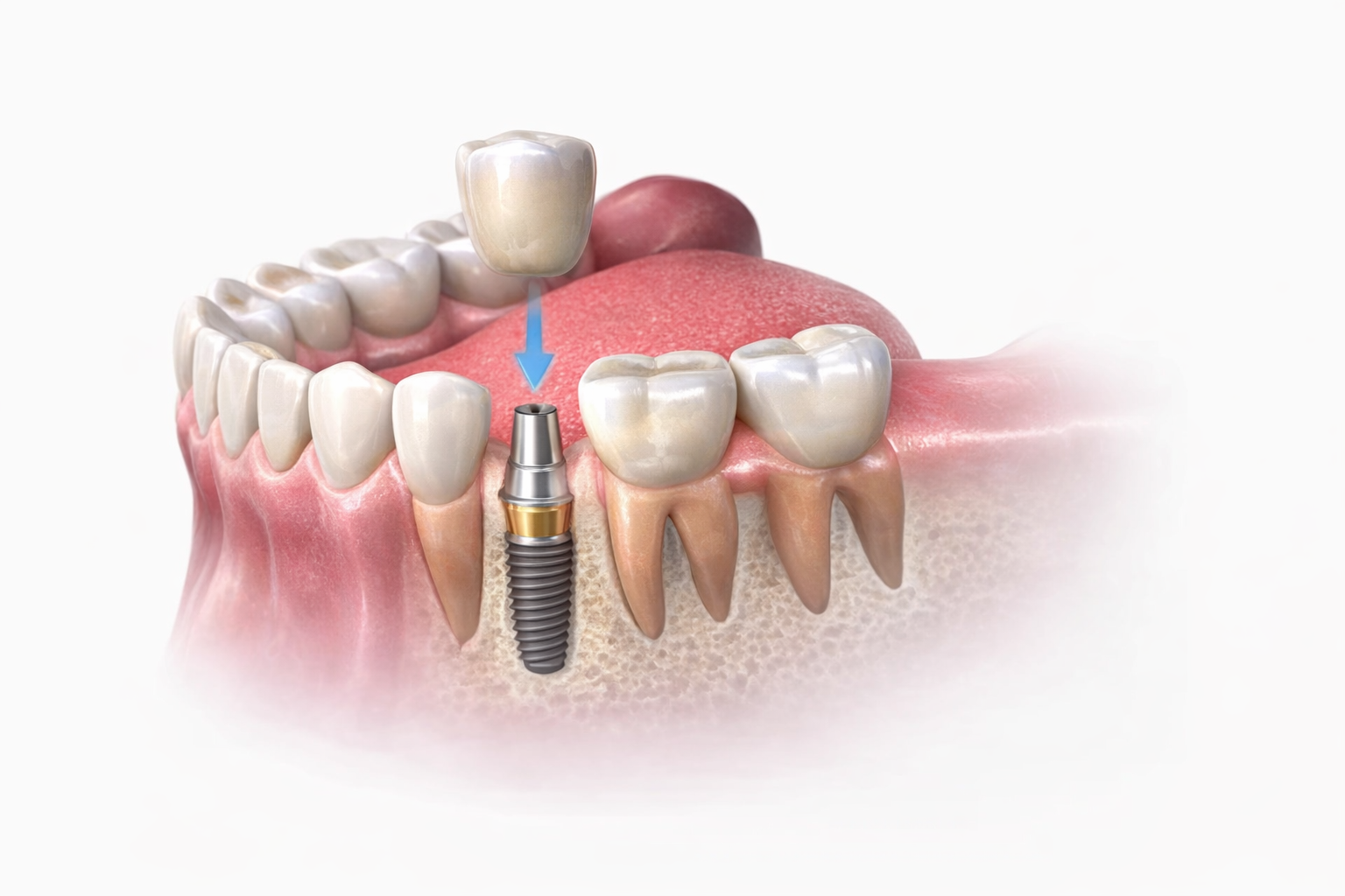 Отсутствие одного зуба