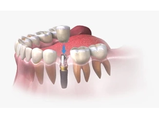 Один имплант