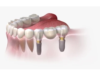Мост на имплантах